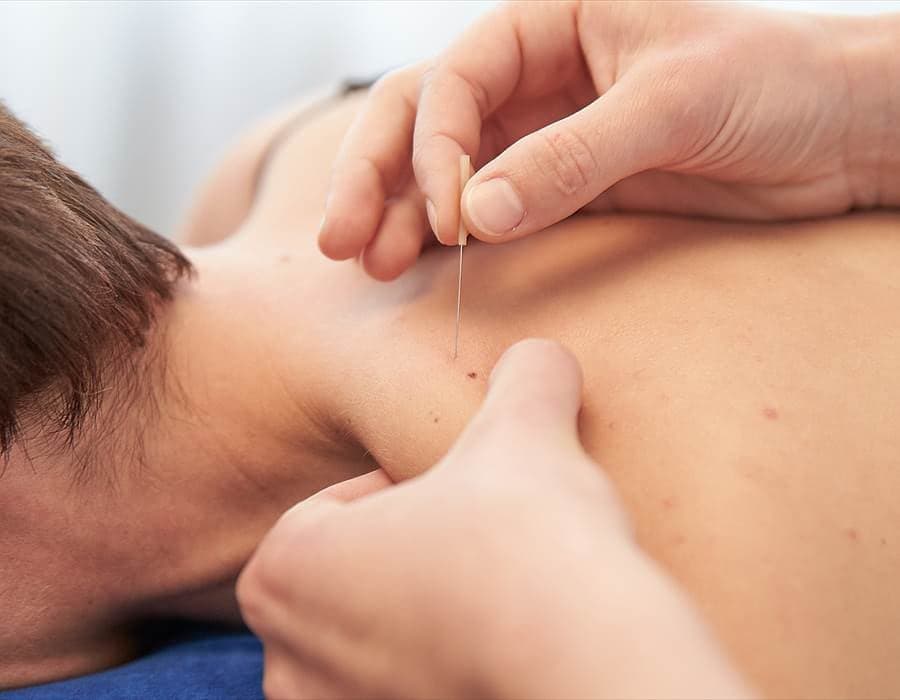 Dry needling: a fine needle in the shoulder muscles